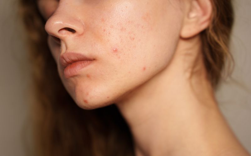 koža, puberteta, najstnica, mozolji, akne