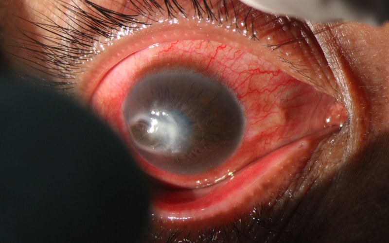 Akantamebni keratitis.jpg