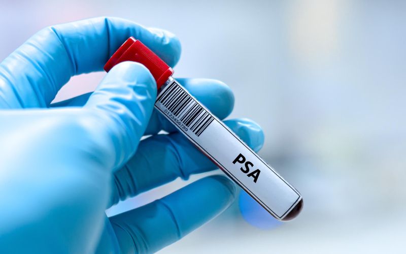 test-rak-prostate