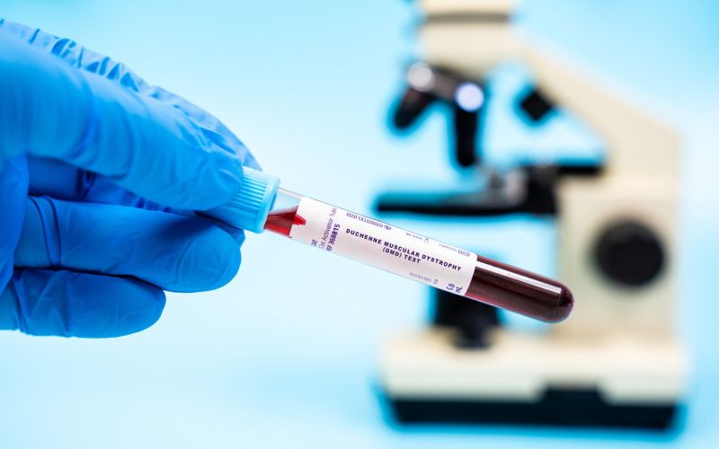 Duchennova mišična distrofija