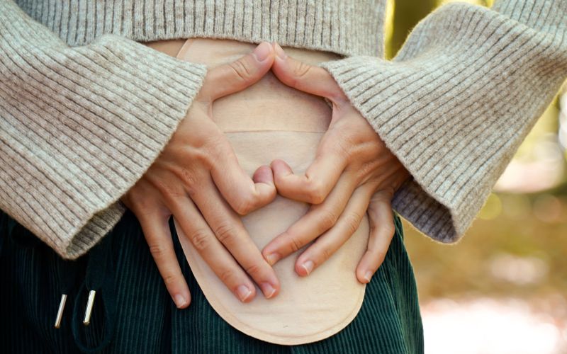 urinska stoma.jpg