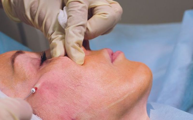 mohs-surgery---procedures--preparation--cost--and-recovery.jpg