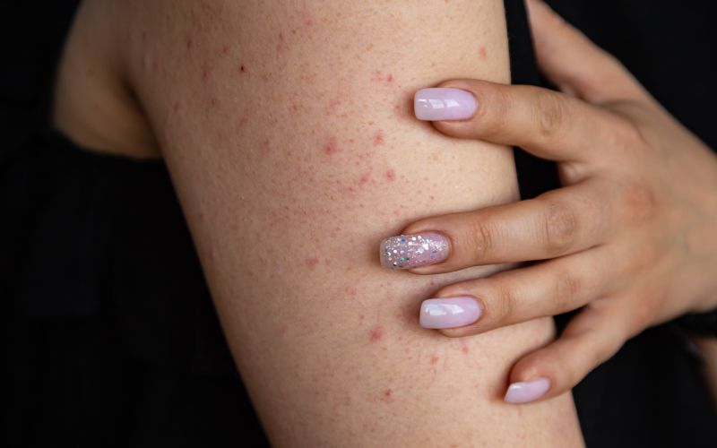keratosis-pilaris