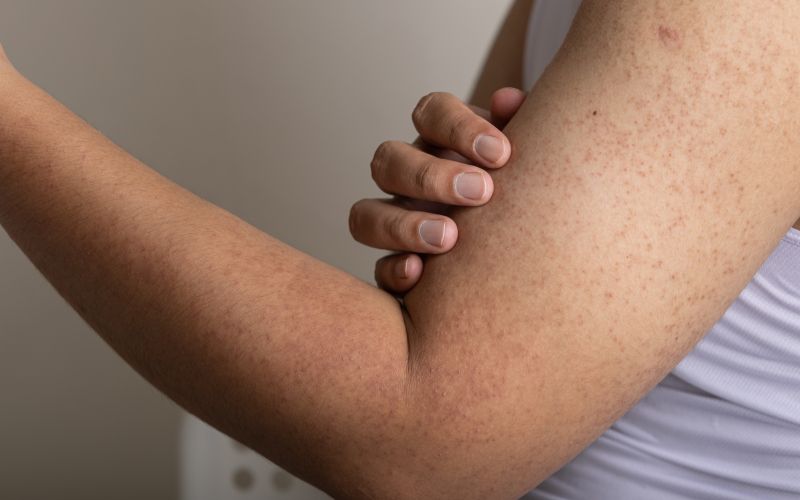 keratoza pilaris, pikice, roke, izpuščaji, koža