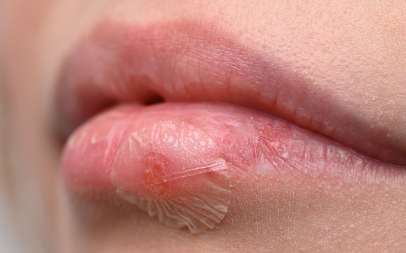 herpes2.jpg