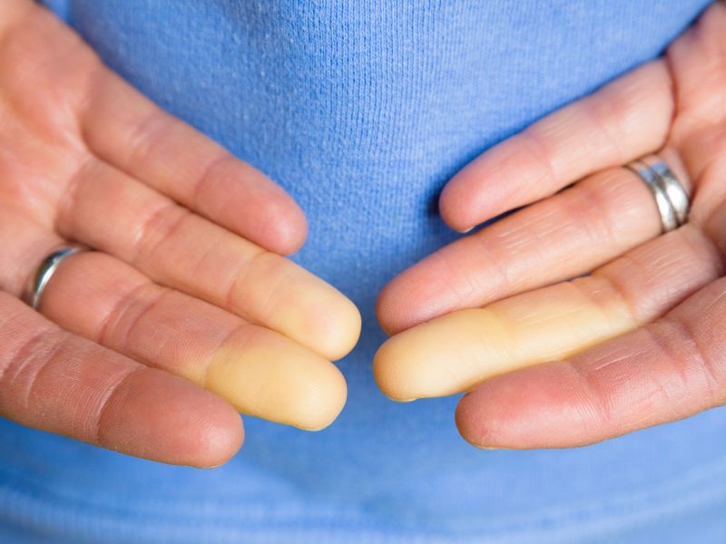 To redko bolezen mnogi ne poznajo, a lahko močno spremeni telo