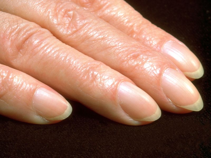 Ne prezrite teh sprememb na nohtih – lahko pomenijo raka