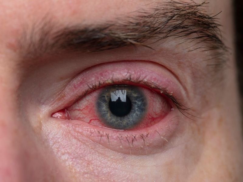 Fotokeratitis ali snežna slepota: ko UV-žarki opečejo oči