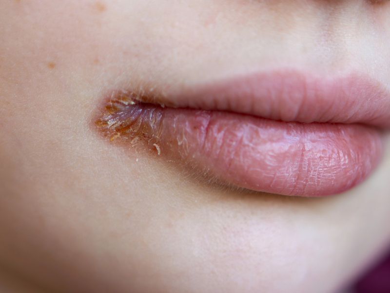 To je razlog za razpoke v kotičkih ustnic