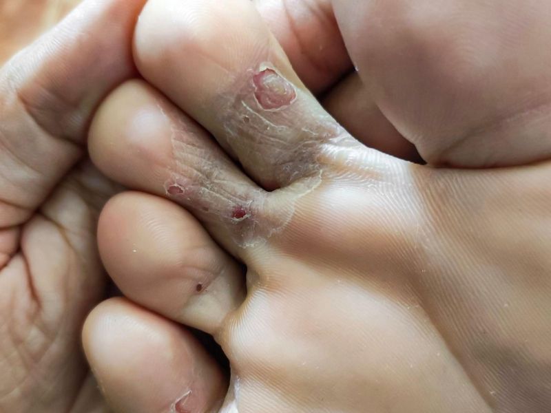 Atletsko stopalo se hitro širi, ukrepajte ob prvih znakih