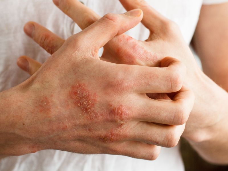 Pozor pri pranju: te snovi v detergentih dražijo kožo