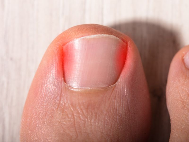 Vas muči vraščen noht? Kako si pomagate sami in kdaj k zdravniku?