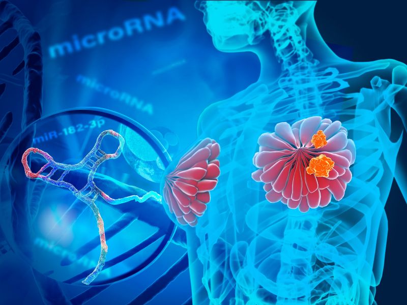 Revolucija zdravljenja raka dojk? Cepivo, narejeno za vsako bolnico posebej