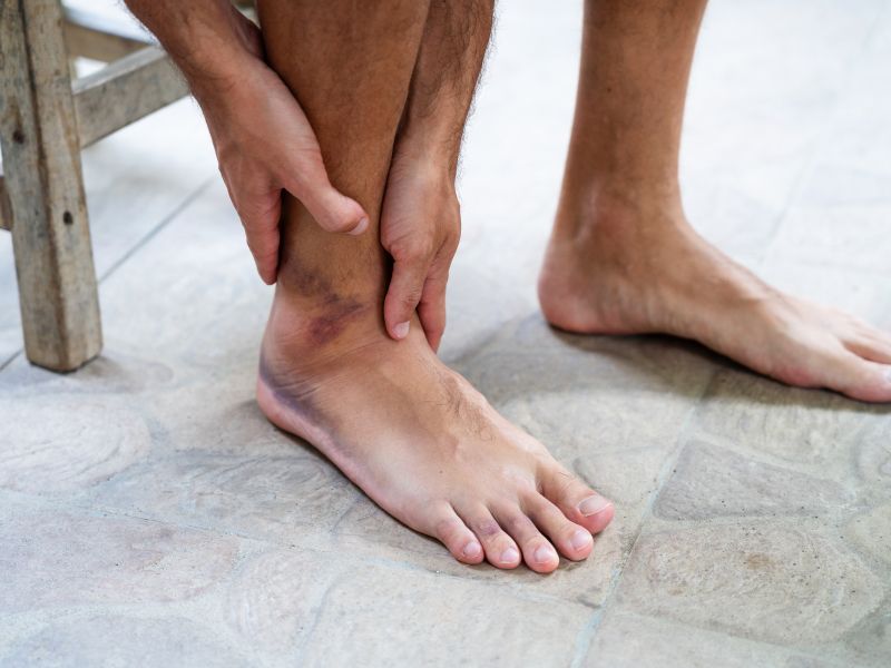 Večina ljudi po zvinu gležnja naredi ravno to napako