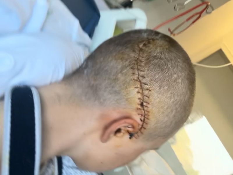 Kolesarska drama! Možganska krvavitev in zlomljena čeljust