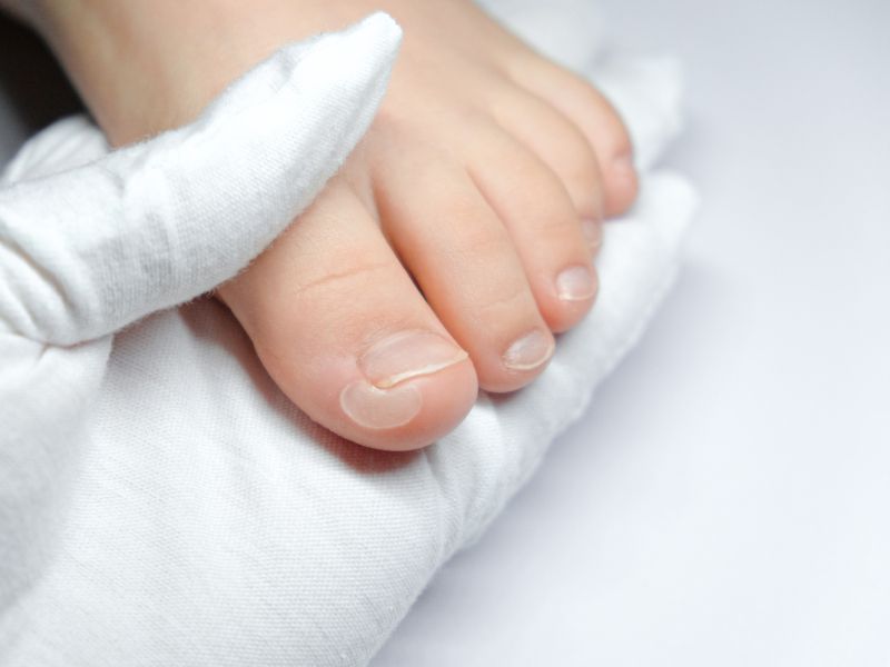 Napačno oskrbljen žulj se je končal z amputacijo prsta