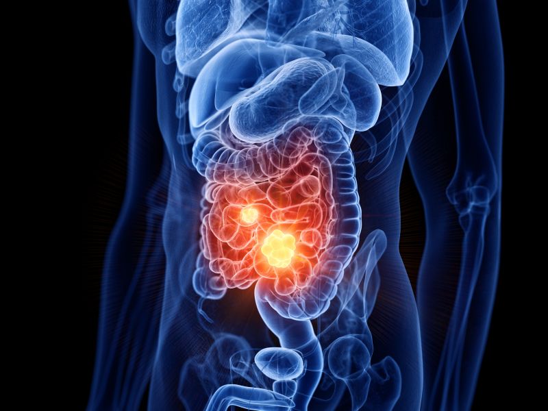 Kdaj je biopsija tankega črevesa neizogibna in kaj razkrije?