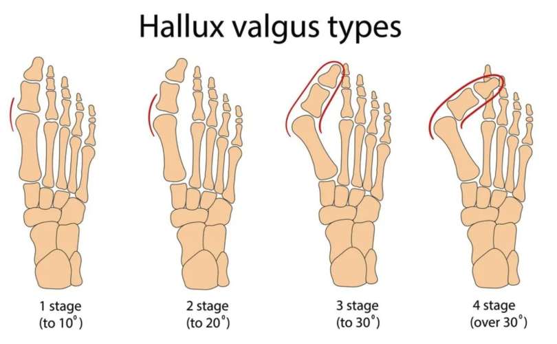 hallux-valgus-stopnje