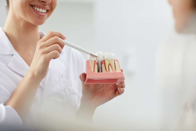 zobni-implantat